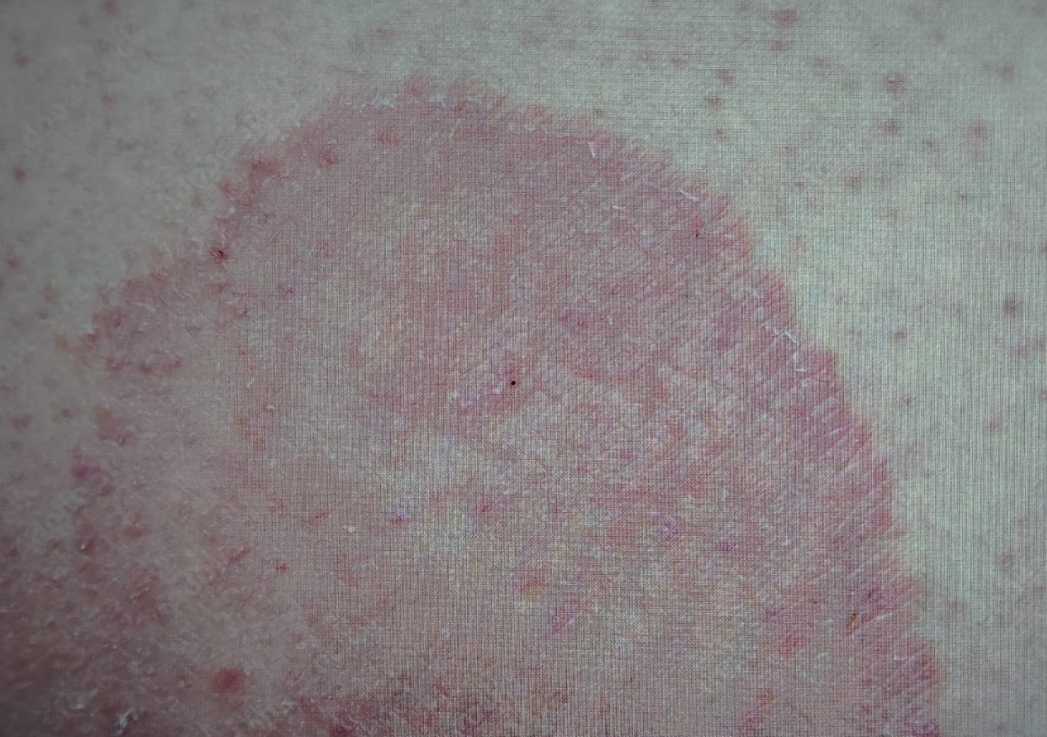Fungal Infections & Ringworm Treatment